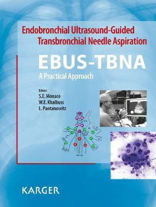 Endobronchial Ultrasound-Guided Transbronchial Needle Aspiration (EBUS-TBNA): A Practical Approach
