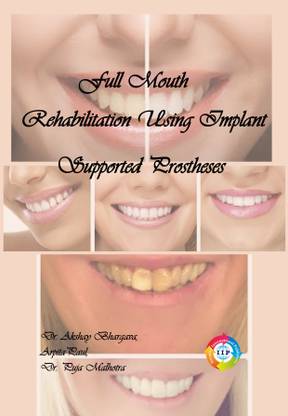 Full Mouth Rehabilitation Using Implant Supported Prostheses