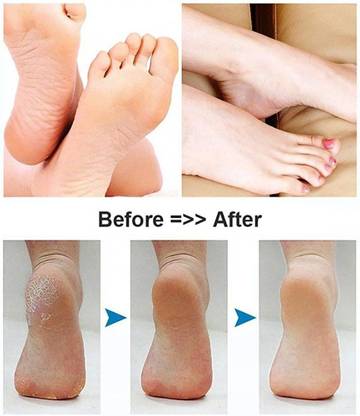 Callus Pedicure Machine