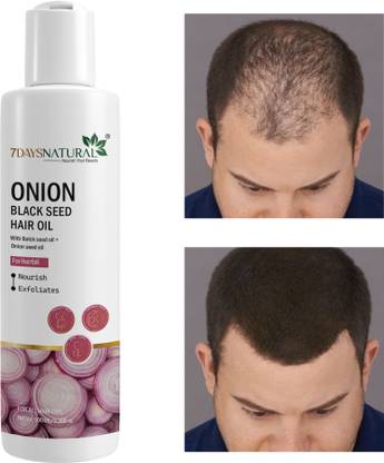 7days natural Onion Oil for Hair Regrowth | Anti Hair Fall | Dandruff | smooth shine hairs Hair Oil