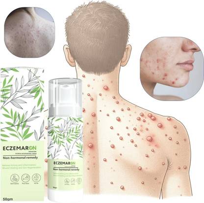 Eczemaron Ringworm Anti Fungal Cream For Men & Women.