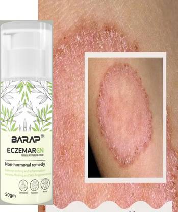 barap eczemaron anti fungal Clear Skin Fast with Ecz Anti-Fungal Cream Boost amar