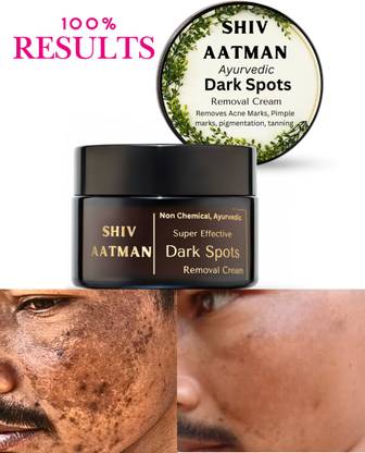 Shiv Aatman Melasma Removal Pigmentation Removal, Dark Spots Removal Cream ( Non Chemical )