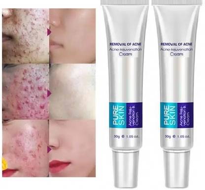 YAWI best result cream, Pimple Marks, Acne Scar, Pigmentation
