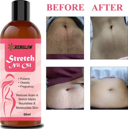 RENGLOW Natural Stretch bio oil-Before and After Pregnancy Stretch marks oil