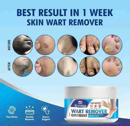 FEZONA Skin Wart Remover Ointment Cream - 100 gm