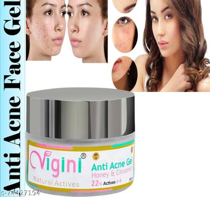 Vigini 22% Actives Anti Acne Face Spot Cream Gel Oily Prone Skin Pimple & Scars Removal