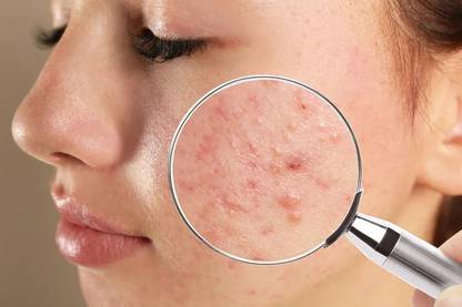WOONGMI Anti - Acne cream For Remove Pimple & Acne Marks