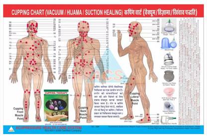 Cupping Therapy Chart - Hijama / Vacuum Paper Print (18 inch X 12 inch) Fine Art Print
