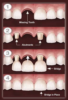 Poster Dental Doctor Bridge Of Tooth Wall Poster (300 Gsm Matte Paper, 13 X 19 Inch, Multicolour) 3D Poster