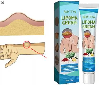 Buy TYA Lipoma Remover Cream 30g | Herbal Bump & Tumor Treatment for Skin