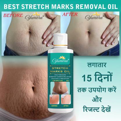 yumora Stretch Marks Oil to Minimize Stretch Marks & Even Out Skin Tone-50ml