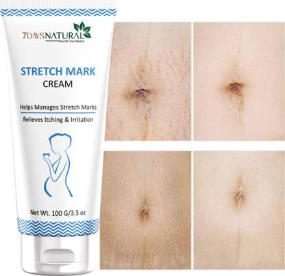 7days natural Stretch Mark Removal Cream For women� before after Pregnancy, During Pregnancy