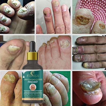 Feminela Onychomycosis Nail growth oil fast, nail strong oil, nail strong and grow faster