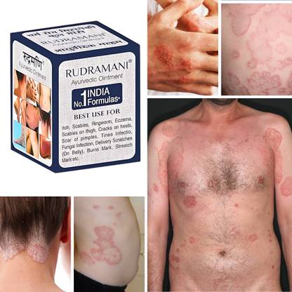 Rudramani Anti fungal Malam - for Ringworm, itching, Eczema .Skin Infection, Skin Recovery