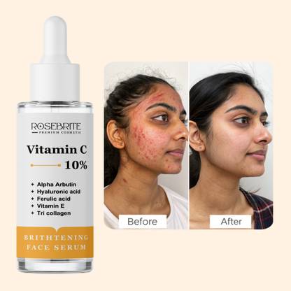 RoseBrite Vitamin C Anti-Spot Serum – Targets Dull, Uneven Skin Tone, Fades Pigmentation & Helps Restore Skin Luminosity