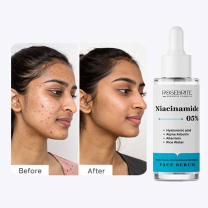 RoseBrite Acne Mark & Hyperpigmentation Serum – Corrects Dark Spots, Refines Skin Texture & Boosts Radiance