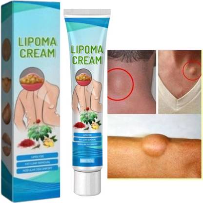 SIYDHA Herbal Lipoma Removal Cream Fat Lipoma Lower Back