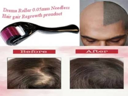 YLDZ Hair Growth Activator Derma Roller For Hair Growth 0.5 mm with 540 Titanium Needles