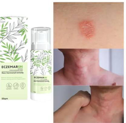 Eczemaron Ringworm Herbal Eczemaron Anti Fungal Cream For Men & Women Orignal Fungal Cream Khujli ...(1)