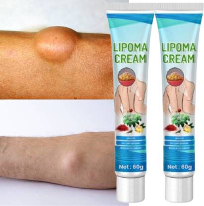 SIYDHA Best Lipoma Removal Cream - Reduce Lumps Easily with Organic Ingredients 2 X 60g