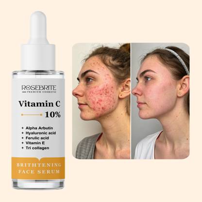 RoseBrite Pigmentation-Fighting Serum – Vitamin C Powered Formula That Clears Spots, Refines Tone & Enhances Radiance Gently
