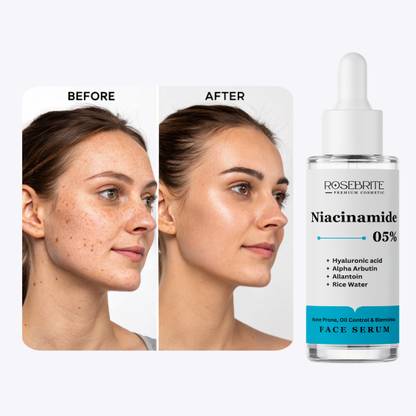 RoseBrite Hyperpigmentation Face Serum – Fights Dark Spots, Acne Scars & Uneven Tone for Glowing, Balanced Skin
