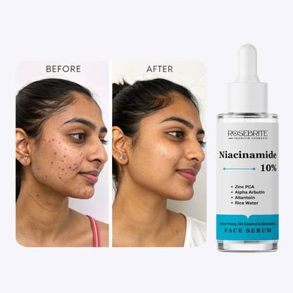 RoseBrite Advanced Blemish Serum – Niacinamide 10% + Zinc PCA Work Together to Control Acne, Clear Skin & Strengthen Barrier
