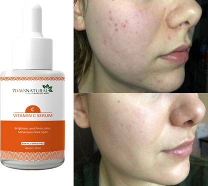7days natural Vitamin C Face Serum for Skin Radiance | dark spot | pigmentation anti blemish