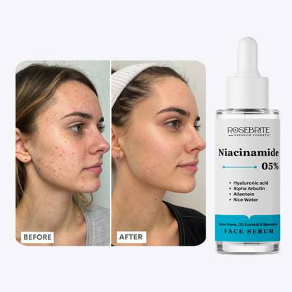 RoseBrite Best Serum for Acne Scars & Dark Spots – Fast-Acting Formula to Lighten Discoloration & Brighten Dull Skin
