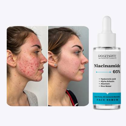 RoseBrite Spot Lightening Face Serum – Targets Post-Acne Hyperpigmentation & Restores Natural Glow