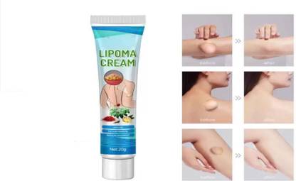 SIYDHA New Lipoma Removal Creamd Easy to Use Care Cream Wide Applaications