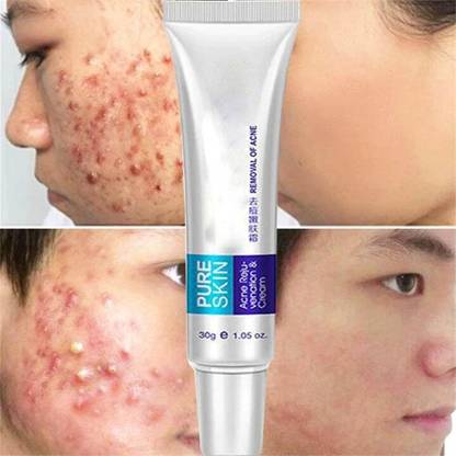 GULGLOW99 Pimple Remover Cream
