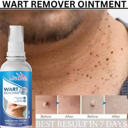 POWERFEEL Wart Remover Ointment Mole Remover & Massa Remover Cream-a1