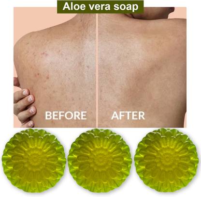 CHITAKSH Aloe Vera Soap with Tea Tree Oil (100GM) (PACK OF 3)