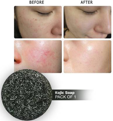 VITRACOS Kojic Acid Soap, Dark Spot Remover Soap with Retinol, Collagen, Hyaluronic Acid