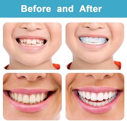 JODIX Natural Teeth Whitening Veneers Instant Perfect Smile Teeth Wipe