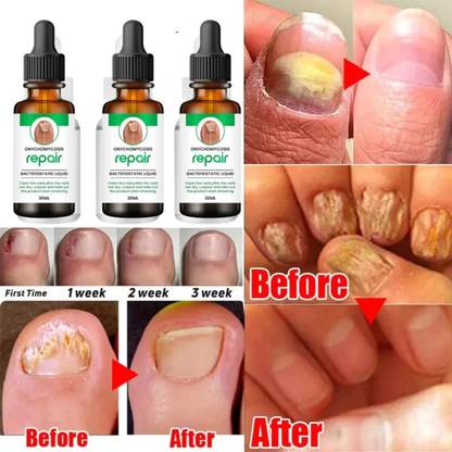 HERBHEAL Onychomycosis Nail growth & strong serum, nail strong and grow faster (90 ml) Men & Women