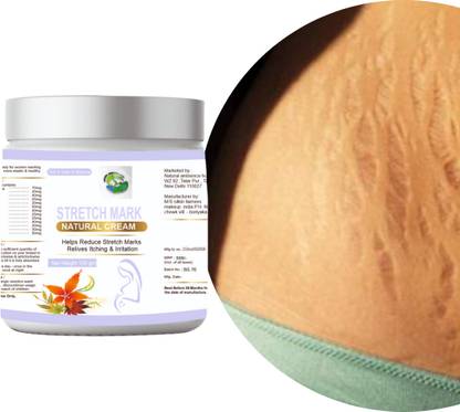 Natural ambience hub Stretch Marks Cream for Reducing Stretch Marks Men & Women