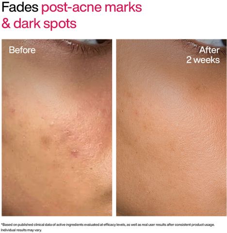 WishCare Advanced Dark Spot TXA Shot | For Pigmentation & Dark