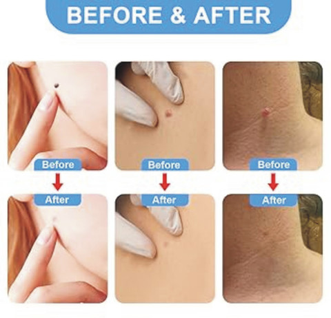 EAXLA Dermasmooth skin tag remover patches strips Skin Tag Remover Patch Pimple Patches Ds-4 Price in India - Buy EAXLA Dermasmooth skin tag remover patches strips Skin Tag Remover Patch Pimple Patches