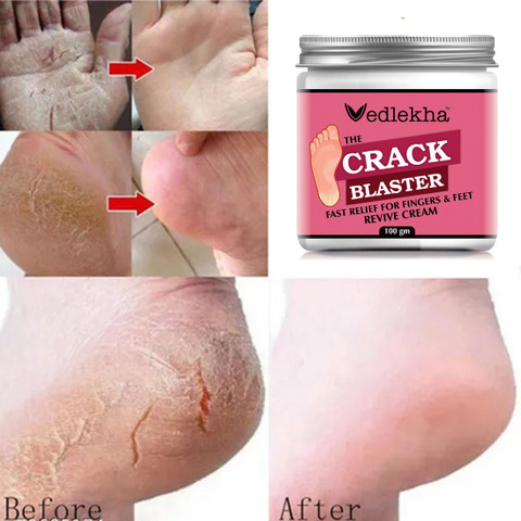 Vedlekha Foot Cracked Repair Cream For Healing Sooting Of Cracked Heels-