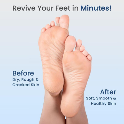 Medtech Electric Callus Remover Foot scrubber for Dead Skin