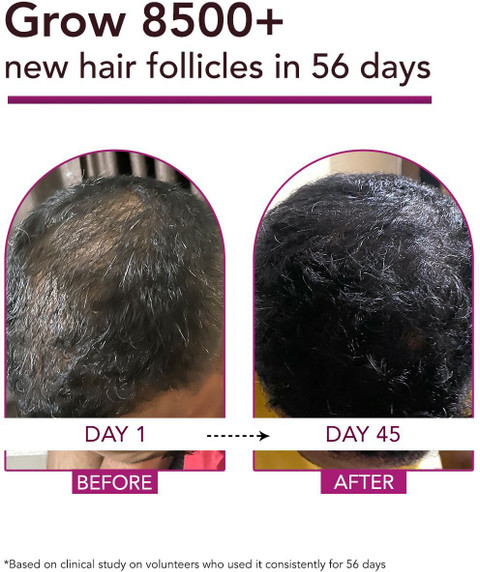 Bontress PRO Plus Hair Growth Serum with 3% Redensyl, 4% Capixyl & 3% ...