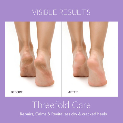 fiora Serenity Foot Repair Cream, Fast Relief for Dry, Cracked