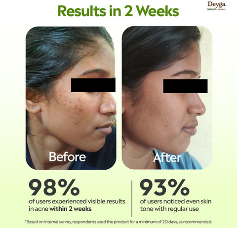 Deyga Aloe Vera Gel 100% Pure Multipurpose for Face, Skin & Hair - Price in  India, Buy Deyga Aloe Vera Gel 100% Pure Multipurpose for Face, Skin & Hair  Online In India,