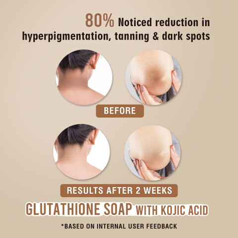 glutathione soap results GLAMVEDA Glutathione & Kojic Acid Soap | Lightens Dark Spots & Acne Scars  Pack Of 3 - Price in India, Buy GLAMVEDA Glutathione & Kojic Acid Soap