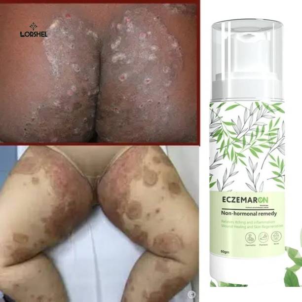 LORSHEL Eczemaron Anti-Fungal Cream for Eczema Symptom Relief