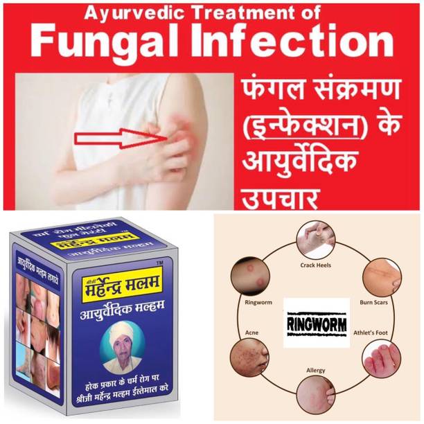 Shreeji Marhendra Ayurvedic Anti fungal Malam - for Ringworm, itching, Eczema & Skin Tretment A