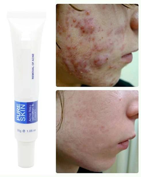 EVERERIN Acne Rejuvenation Cream For Scars, Acne